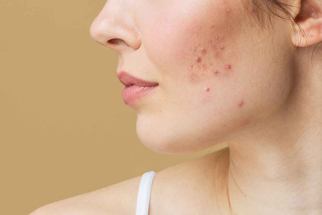 Die Grundlagen von acne verstehen acne