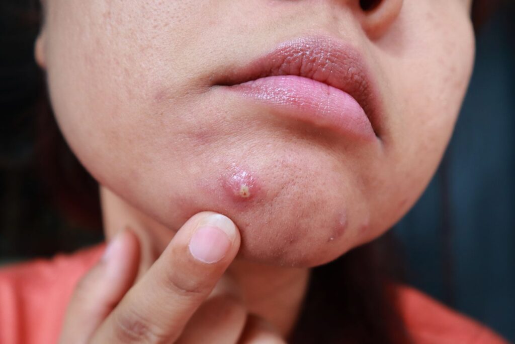 Was ist cystic acne und wie wird sie behandelt? cystic acne