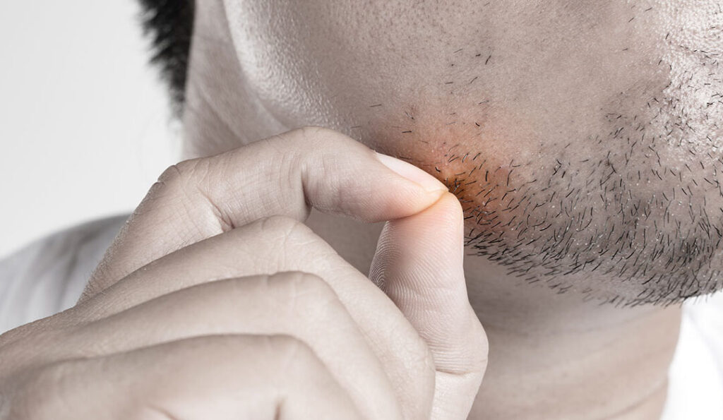 Ingrown hair: Symptome, Behandlung und Vorbeugung ingrown hair