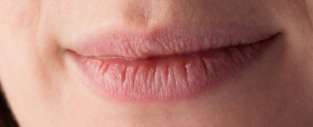 trockene lippen krankheit