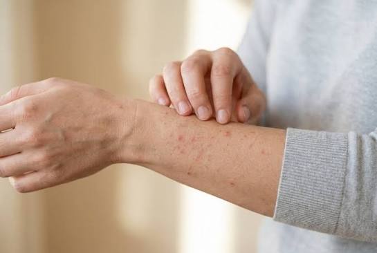 Milben Ausschlag im Gesicht: Symptome, Ursachen und Behandlung milben ausschlag im gesicht